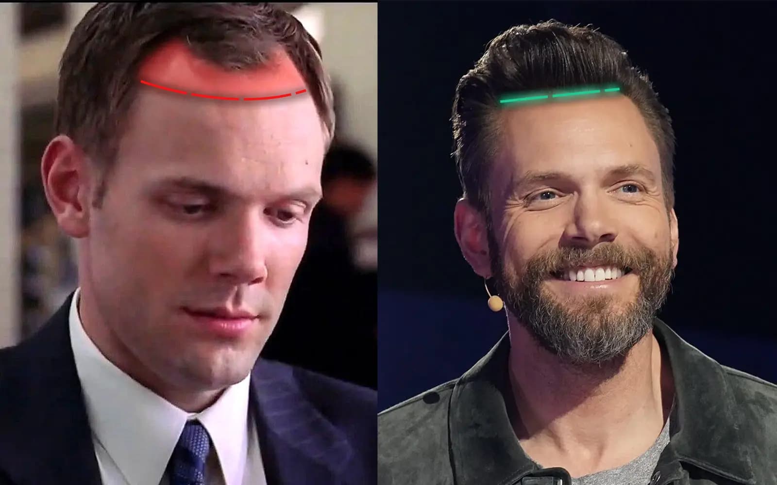 New York Hair Replacement That Looks Authentic